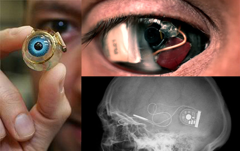 The Mind's Eye: Using Cameras and Implants to Aid in Vision Loss
